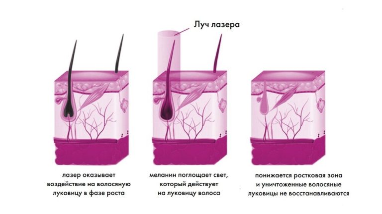 Купить медицинские справки в Москве онлайн. Лазерная эпиляция